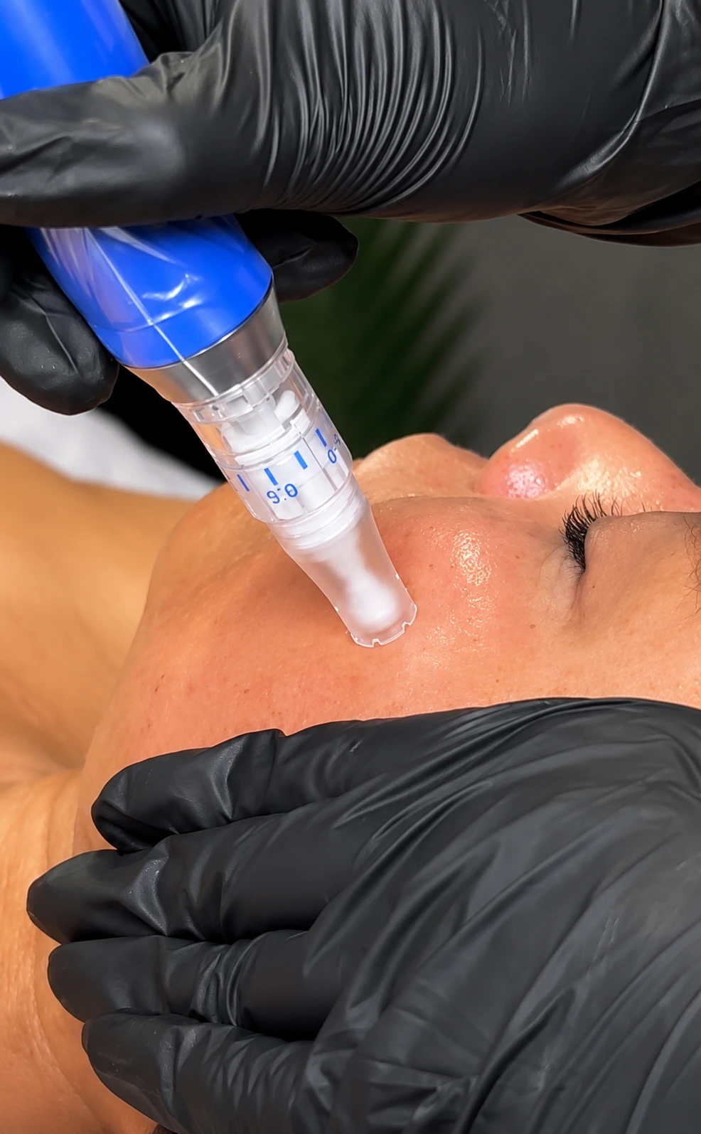 Close-up of a microneedling facial treatment with a handheld pen device